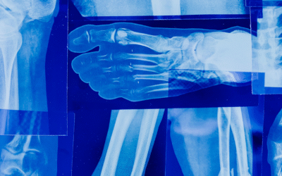L’osteoporosi